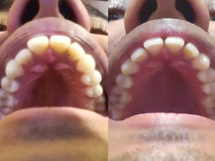 Picture of mewing teeth before and after effects